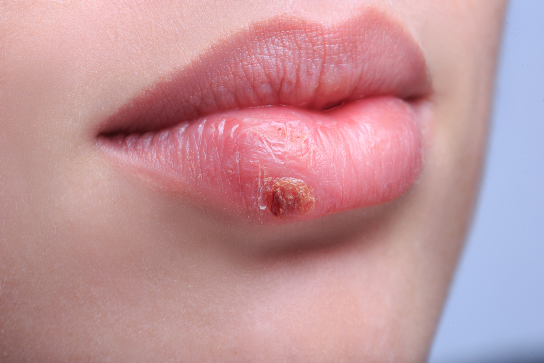 Is Herpes Rare Or Common