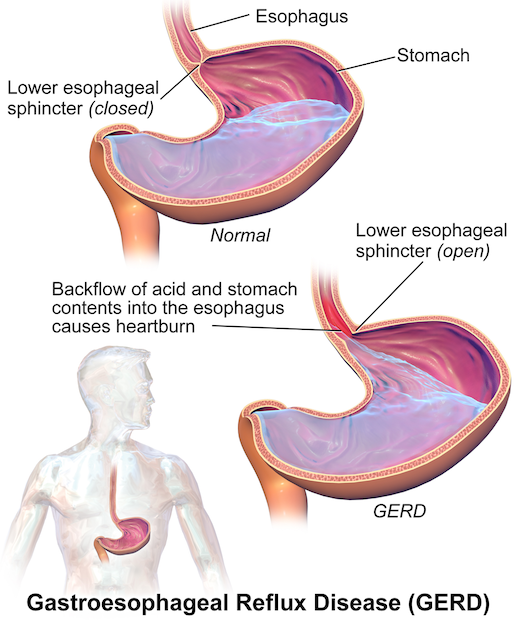 how-does-pantoprazole-treat-gerd